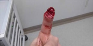 Wild boar bites off man’s finger