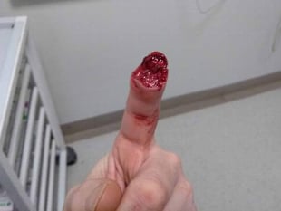 Wild boar bites off man’s finger