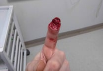 Wild boar bites off man’s finger
