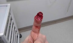 Wild boar bites off man’s finger