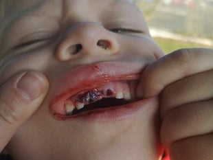 Hammer horror of six-year-old Lydney schoolboy