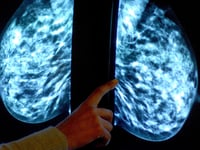 Breast screening uptake in Gloucestershire remains below pre-pandemic levels