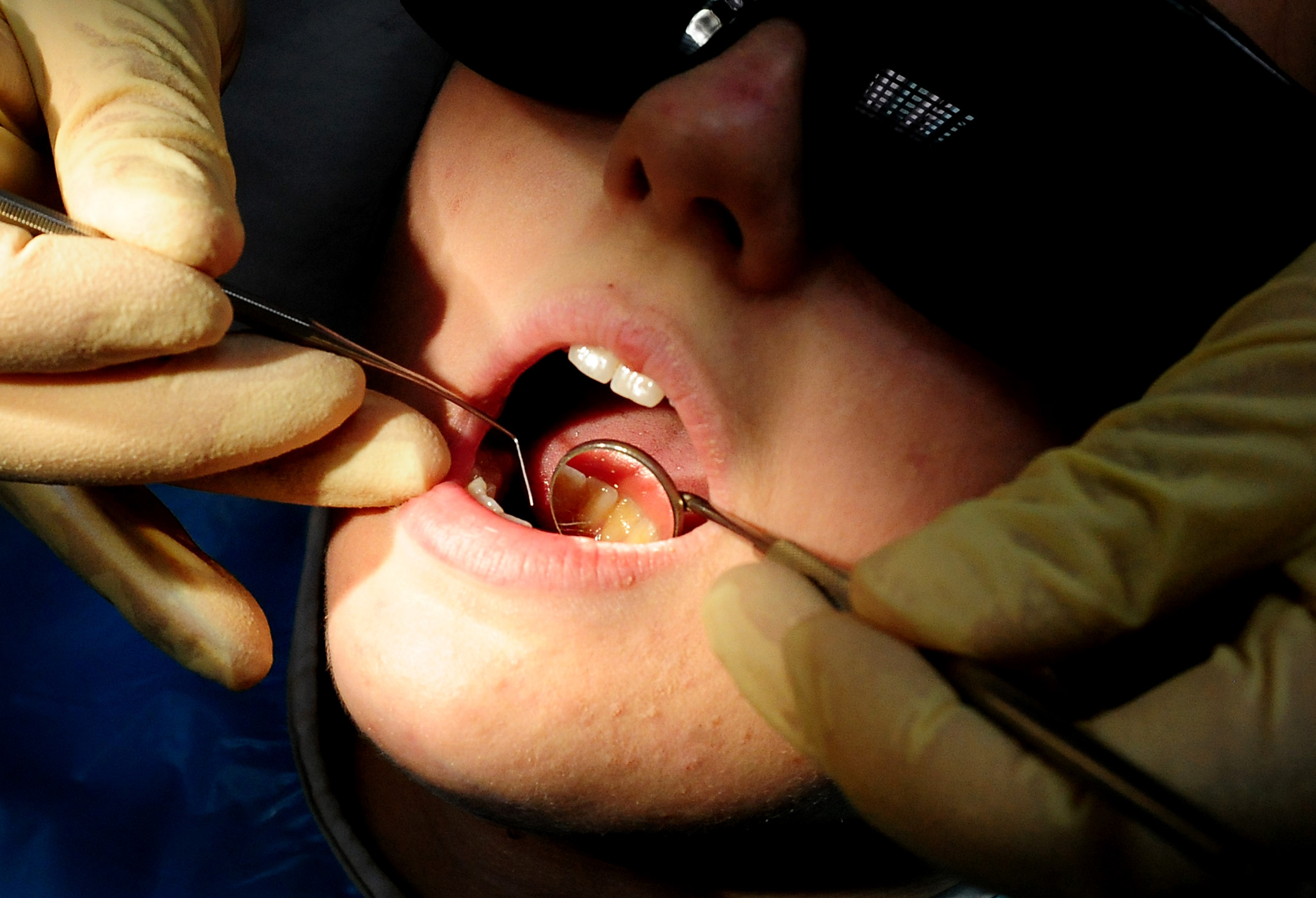 Dozens of hospital admissions in the Forest of Dean to remove children's rotten teeth