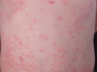NHS Gloucestershire gives measles advice