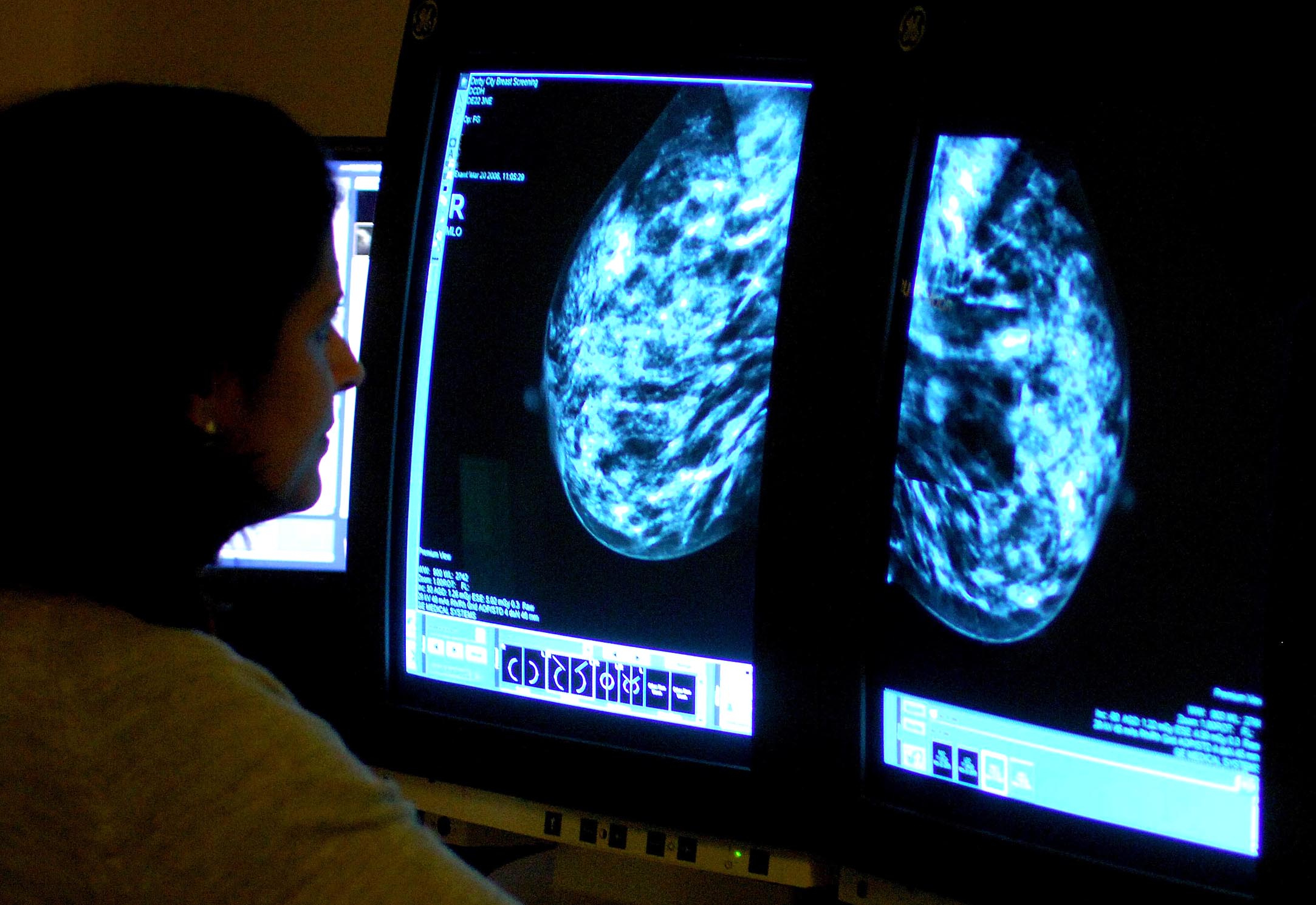 More women in Gloucestershire undergo breast cancer screening – as NHS England target met for first in five years